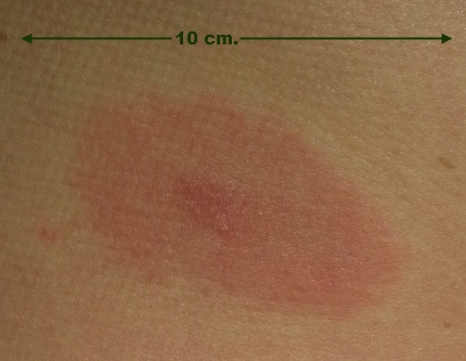 Wie daarmee besmet raakt, ziet een rode kring rondom de tekenbeet verschijnen (foto: Archief JHB)